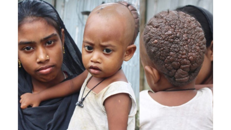 মাথায় বিরল রোগ আক্রান্ত কুড়িগ্রামের সিফাত, সহযোগিতার আবেদন